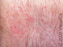 Image result for Dry Skin