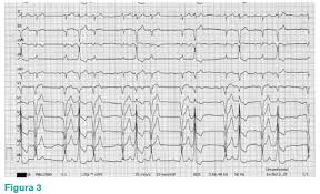 See full list on humanitas.net Trasee Electrocardiografice Comentate Stetoscopcardio