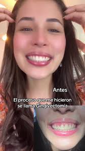 Gingivectomía: Transformación de Sonrisa en Managua