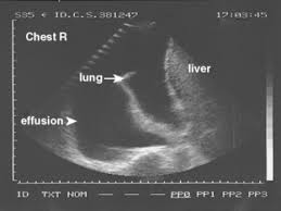 Ultrasound findings are relevant for pleural infection as in heavily septated or loculated effusions, the biochemical results can be different in the discrete areas, so can give falsely reassuring results. The Pleura Radiology Key