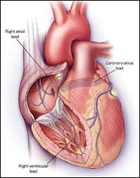 Does it give you shocks? Biventricular Pacemaker Merrimack Valley Cardiology