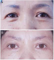 Asian female patient who was beginning to notice her upper eyelids were beginning to sag and cause her upper dr. Waaps Asian Women Eyebrow Lifting Direct Brow Lift Facebook