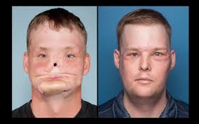 A california man who underwent grueling face transplant surgery earlier this year revealed his new self to the world on thursday. 3d Printing Helps To Perform Rare And Life Changing Facial Transplant For Wyoming S Andy Sandness 3d Printing Industry