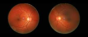 Retinal Diseases: Types, Symptoms, and Causes