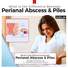Image result for Perianal Abscess