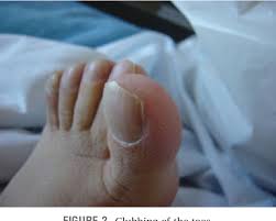 Image result for Clubbing nails feet