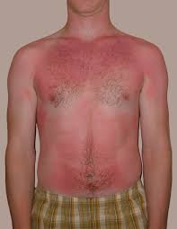 Symptoms of 1st degree burn. Burns Amboss