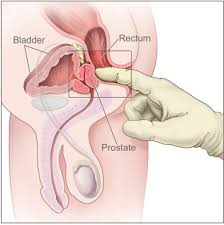 Colorectal cancer is one of the most common cancers in both men and women nationwide. Digital Rectal Examination For Prostate Cancer Screening Performed With Colonoscopy For Colon Cancer Screening 2 For The Price Of 1 Gastrointestinal Endoscopy