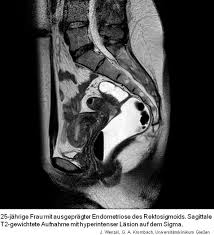 Endometriose ist eine häufige, gutartige, oft schmerzhafte chronische erkrankung von frauen, bei welcher der gebärmutterschleimhaut (dem endometrium) ähnliches gewebe außerhalb der gebärmutterhöhle (ektop) vorkommt. Schonende Diagnose Der Endometriose Mrt Spurt Schleimhautinseln Auf Drg De