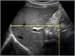 The Radiology Assistant Normal Values Ultrasound