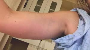 Blood clots are a collection of sticky blood cells that form when a blood vessel is damaged. The Blood Clot That Could Have Killed Me