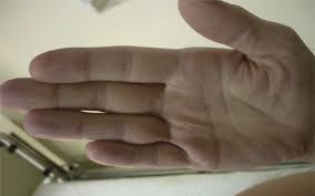 A motor disorder characterized by jerking movements (as of the outstretched hands) and associated with various encephalopathies due especially to faulty metabolism. Liver Pain An Overview Sciencedirect Topics