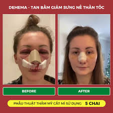 Dung Dịch Uống, Thực Phẩm Bảo Vệ Sức Khỏe Dehema 100ml Hỗ Trợ Giảm Sưng,  Bầm Tím Nhanh Chóng
