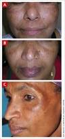 Image result for Melasma