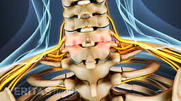 Maybe you would like to learn more about one of these? Osteophytes Definition Back Pain And Neck Pain Medical Glossary