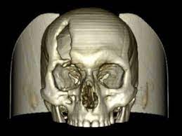 Invesalius generates 3d medical imaging reconstructions based on a sequence of 2d dicom files acquired with ct or mri equipments. Invesalius