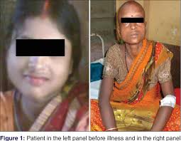 Loss of more than 10 percent is strong indication. Figure 1 From Hodgkin S Lymphoma Presenting As Alopecia Semantic Scholar