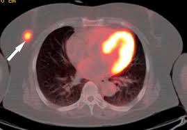 Mammography, ultrasound, and breast mri help accurately stage local disease extent, whereas bone scan, abdominal ct or mri, chest ct, and fdg pet/ct play a role in systemic staging. Fdg Pet Ct For The Detection And Evaluation Of Breast Diseases Usefulness And Limitations Radiographics