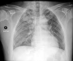 Image result for Hemothorax