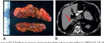 Biochemically, ppnad is characterized by elevated levels of plasma and urinary cortisol that are not suppressed by high doses of dexamethasone (8mg/d for 2 days). Figure 23 6 From Familial Pituitary Tumors Semantic Scholar