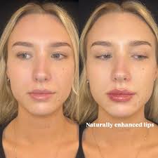 Multi-area enhancement. Treating the lips, chin shadow, and pyriform fossa  😍 (I find it hard to show case the pyriform fossa