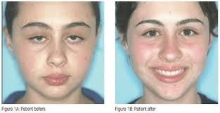 Image result for Adenodolichos