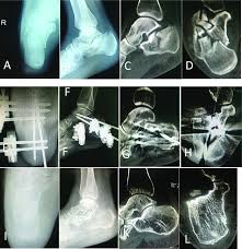 Image result for Calcaneus Compression Fracture