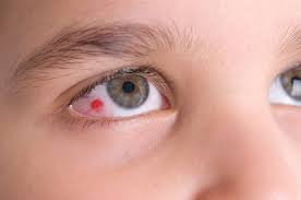 Image result for Conjunctivitis