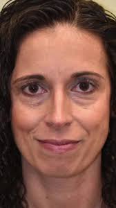 Before and after lower blepharoplasty, fat repositioning, laser  resurfacing. A deadly combo for dark circles, wrinkles and under eye bags!  #plasticsurgery #blepharoplasty #eyelidsurgery #undereyebags ...