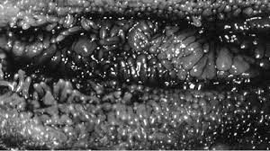 The origin of vestibular papillomatosis (vp) is controversial. Figure 1 From Biomolecular Study Of The Correlation Between Papillomatosis Of The Vulvar Vestibule In Adolescents And Human Papillomavirus Semantic Scholar