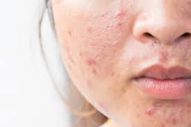Image result for acne face