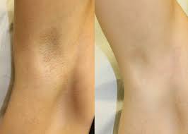 The use of chemicals to break down and burn hair follicles is the major disadvantage with. Laser Hair Removal Clearskin Newcastle Amazing Results