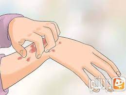 أسباب الطفح الجلدي وأنواعه وعلاجه