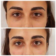 Fotos Ojeras Antes y Después ✔️ Tratamiento para Quitar Ojeras