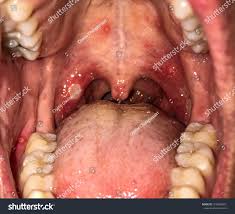 Image result for Mouth ulcers symptoms roof of the mouth
