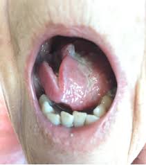 Throat that does not go awaypain or difficulty with chewing or swallowingswelling of the jawhoarseness or other change in the voicepain in the it felt like it was on the floor of my mouth between my side teeth and my gum on the left. Cancers Of The Head And Neck Robot Head And Neck Surgery