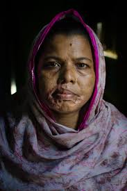 A Pregnant Woman and her mother under an acid attack at Chadpur
