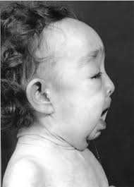 Cutis Laxa and Premature Aging Syndromes