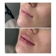 Best way to start the new year is with a new set of gorgeous lips 😍 Scroll  to see the beautiful before and afters of my lovely patient who came in  today