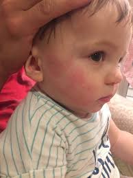Milk allergy is an acute reaction by the infant's immune system to dairy products especially cow's milk. Symptoms And Managing Cows Milk Protein Allergy For Baby Just Simply Mom