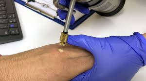 Image result for Cryotherapy