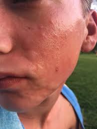 The cause of this disease is difficult to diagnose correctly despite all today, in this article, i would like to reveal some of the best home remedies for hives on neck and face that are proven to work efficiently for treating this. Tick Bitten Teen Now Allergic To Meat Cape Gazette