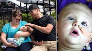 Sobrevive tras nacer con el cerebro fuera del cráneo