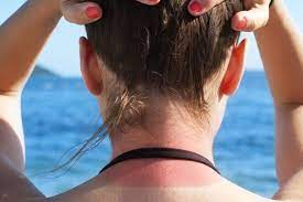 Sonnenbrand Dauer Und Tolle Behandlungstipps Brigitte De