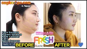 South Korea Plastic Surgery South Korea Plastic Surgery Engfreshps Com South Korea Plasti Plastic Surgery Korean Plastic Surgery South Korean Plastic Surgery