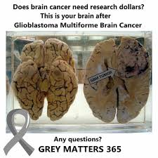Pin On Glioblastoma