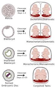 Monozygotic Twin Types Dichorionic Diamniotic Monochorionic Diamniotic Monochorionic Monoamniotic Conjoined Twin Midwifery Student Midwifery Types Of Twins