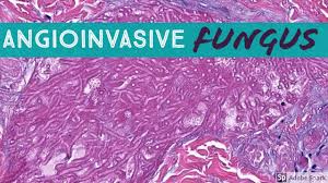 Mucormycosis is any fungal infection caused by fungi in the order mucorales.:328 generally, species in the mucor, rhizopus, absidia, and cunninghamella genera are most often implicated. Mucormycosis Aspergillosis Angioinvasive Fungal Infection Youtube