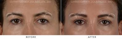 Asian brow lift before and after. Endoscopic Brow Lift Before And After Photo Gallery