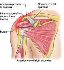 The shoulder is one of the largest and most complex joints in the body. Supraspinatus Tendinitis Morphopedics Rotator Cuff Supraspinatus Tendonitis Rotator Cuff Tear